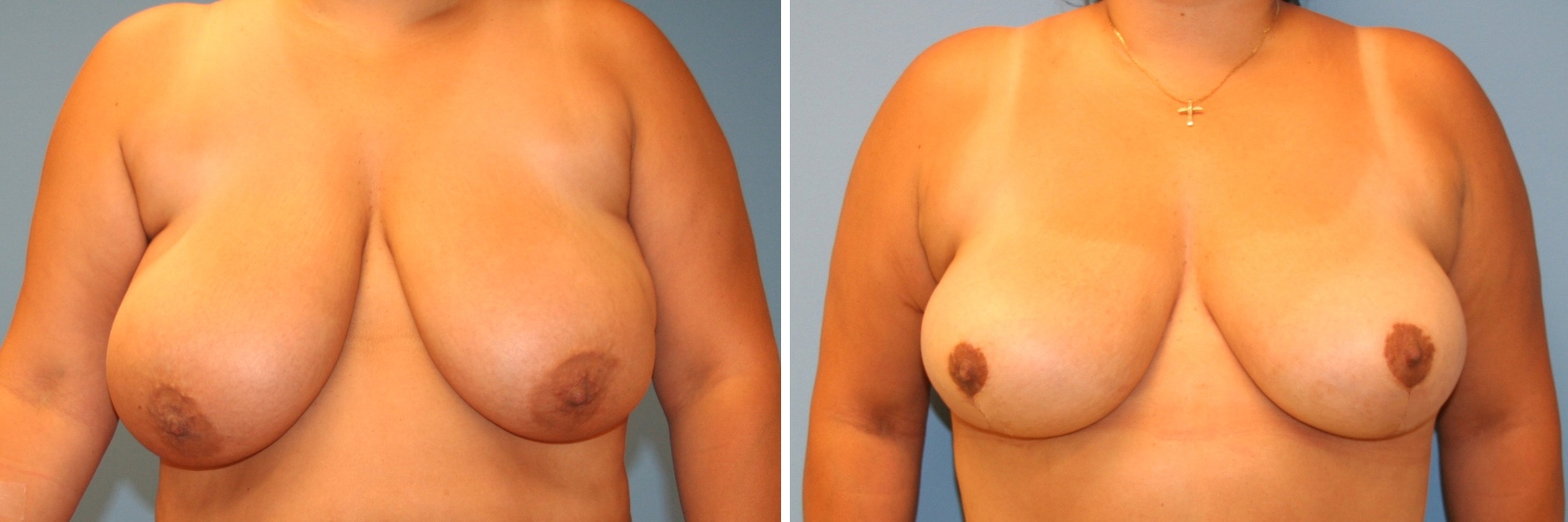 Boob lift before and after photos