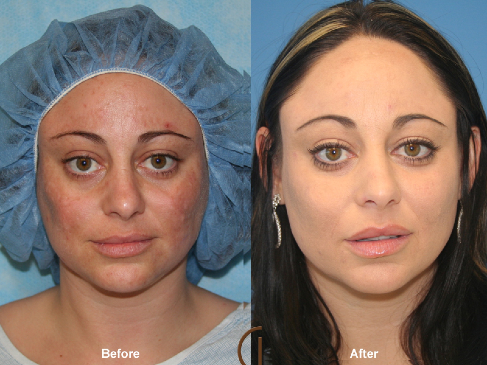 Treat Acne Scars with Punch Excision and Skin Grafting