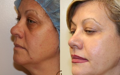 fat transfer to breasts cost