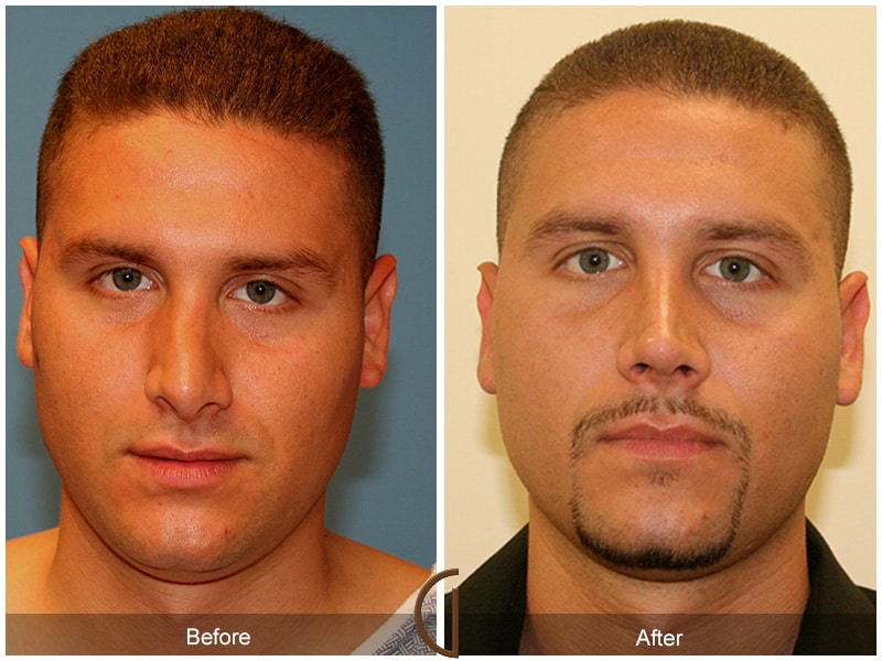 Cosmetic Surgery For Men Only Cost 26