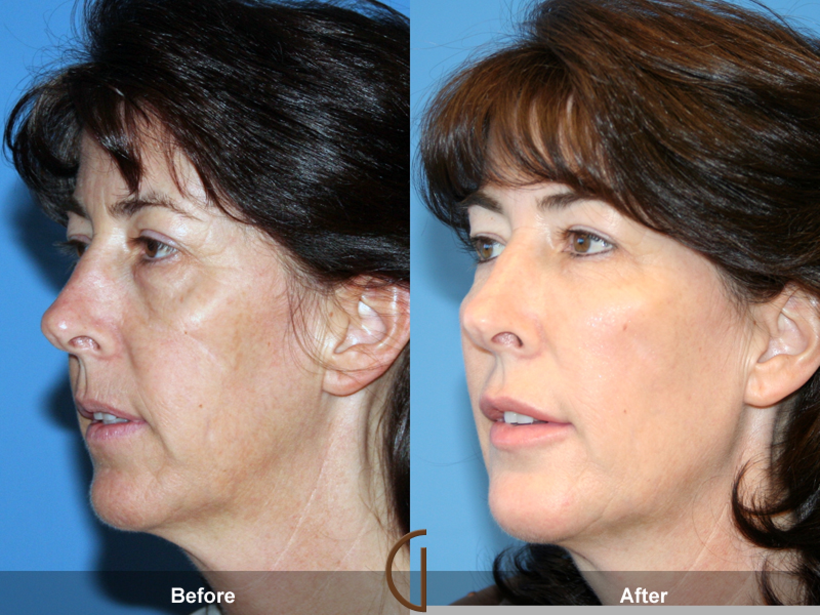 Before & After Fat Grafting to Face 21 | California Fat Transfer