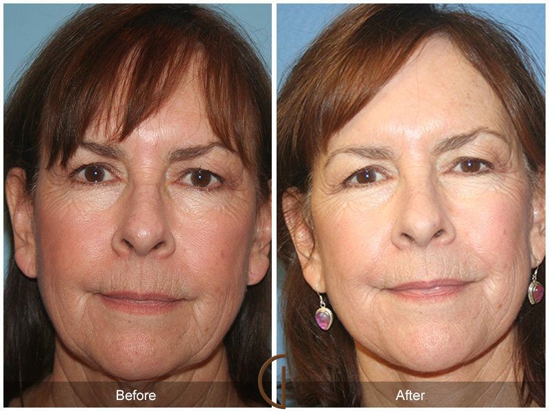 Newport beach facial surgery Key to giving an clitoral orgasm