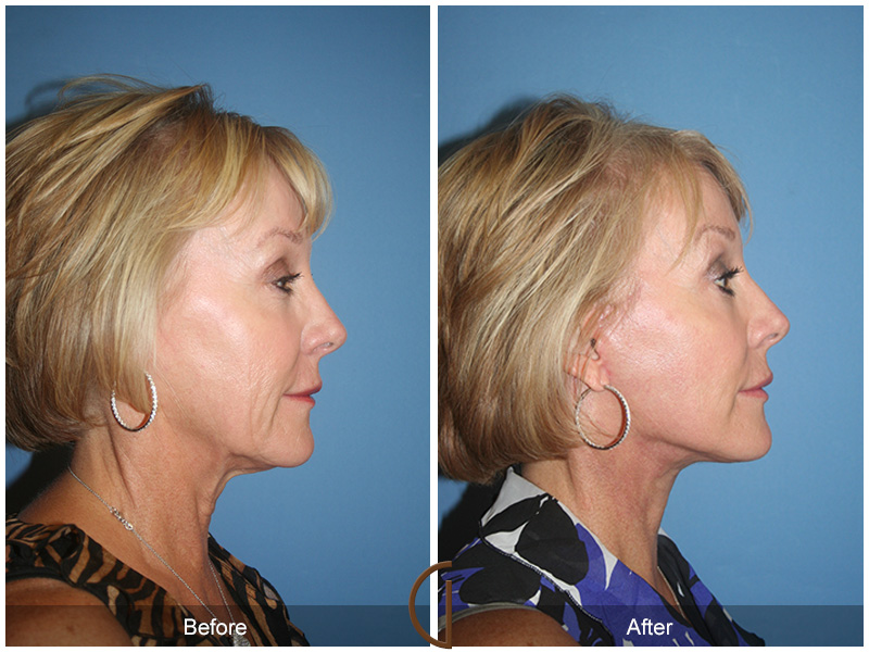 Busty asian password Newport beach facial surgery