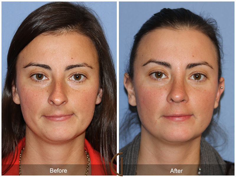 what is rhinoplasty