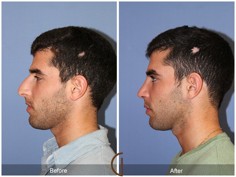 Will i lose weight if i take levothyroxine image 1