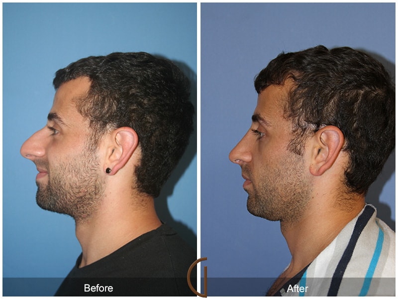 laser lift before and after