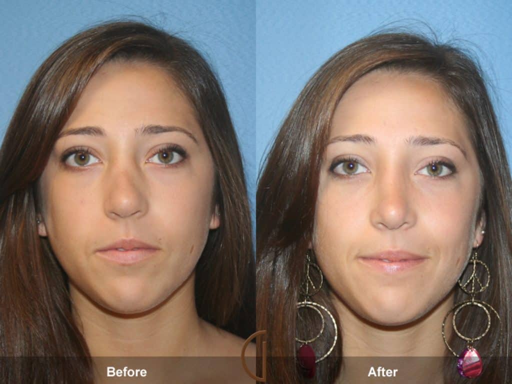 cosmetic surgery on teenagers Cosmetic surgery can be appropriate in selected teenagers and can be safely done in 2013, the american society of plastic surgeons (asps) published data showing that number of cosmetic surgery done for the teens has actually come down progressively over the years, in contrast to the media reports suggesting otherwise. cosmetic surgery on teenagers Cosmetic surgery can be appropriate in selected teenagers and can be safely done in 2013, the american society of plastic surgeons (asps) published data showing that number of cosmetic surgery done for the teens has actually come down progressively over the years, in contrast to the media reports suggesting otherwise.