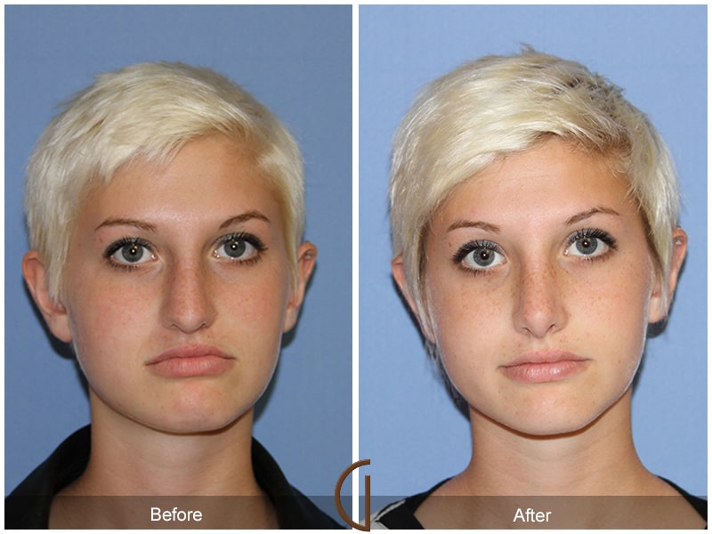 cosmetic surgery on teenagers Cosmetic surgery can be appropriate in selected teenagers and can be safely done in 2013, the american society of plastic surgeons (asps) published data showing that number of cosmetic surgery done for the teens has actually come down progressively over the years, in contrast to the media reports suggesting otherwise. cosmetic surgery on teenagers Cosmetic surgery can be appropriate in selected teenagers and can be safely done in 2013, the american society of plastic surgeons (asps) published data showing that number of cosmetic surgery done for the teens has actually come down progressively over the years, in contrast to the media reports suggesting otherwise.