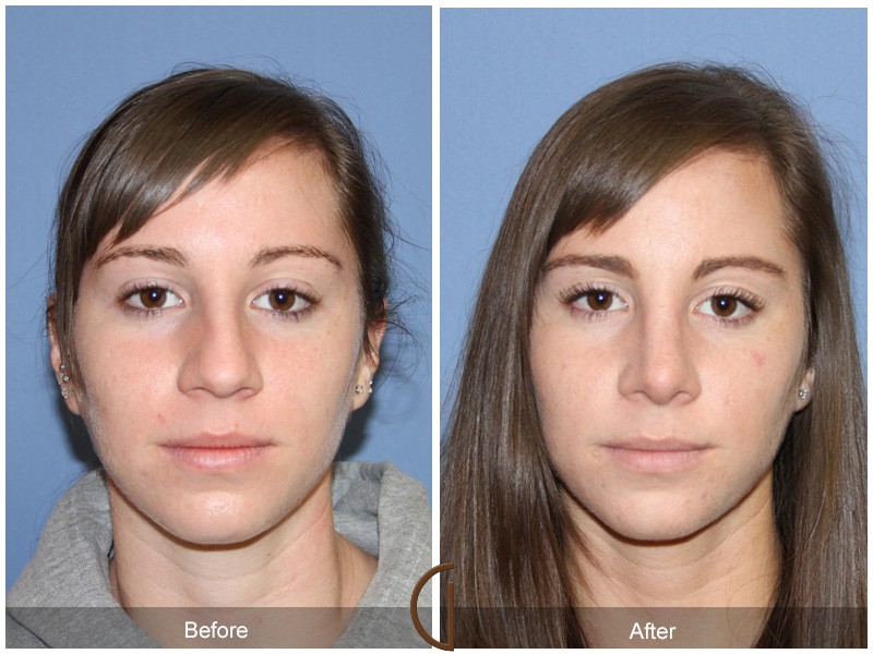 Swollen Turbinates Natural Treatment Swollen Turbinates Natural Treatment
