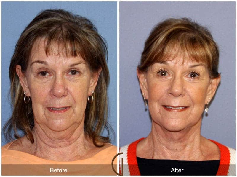 Newport beach facial surgery Wife controls sexual release