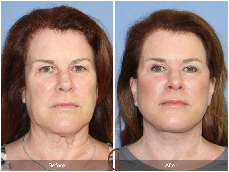 Photo Gallery Before And After Cosmetic Surgeon In The | before after facelift 121 orange county facial plastic Photo Gallery Before And After Cosmetic Surgeon In The | before after facelift 121 orange county facial plastic