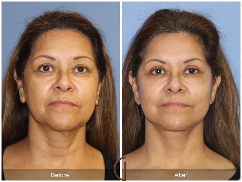 Boys and penetration pictures Newport beach facial surgery